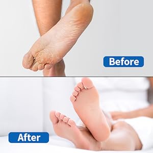 Electric Callus Remover Pedicure Kit For Smooth Feet